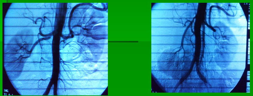 имплантация правой почечной артерии на 2 см ниже в аорту у больной вазоренальной гипертонией
